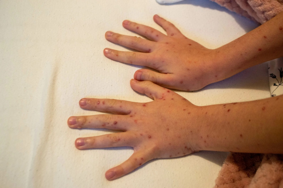 Damares apresenta projeto para criar semana de conscientização sobre doença falciforme